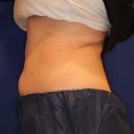 Emsculpt NEO Before & After Patient #14260