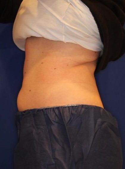 Emsculpt NEO Before & After Patient #14260