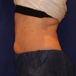 Emsculpt NEO Before & After Patient #14260