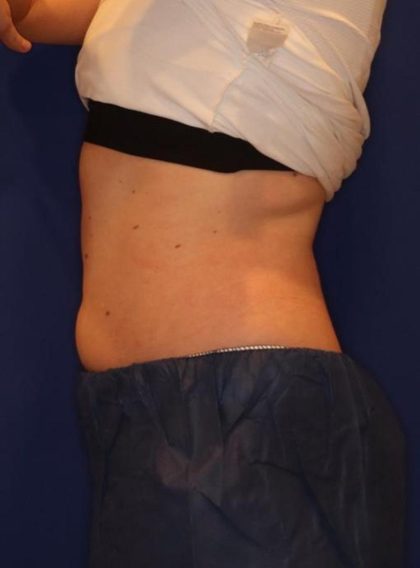 Emsculpt NEO Before & After Patient #14260