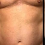 Emsculpt NEO Before & After Patient #14249