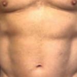 Emsculpt NEO Before & After Patient #14249