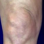 Knee Tightening Before & After Patient #14189