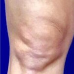 Knee Tightening Before & After Patient #14189