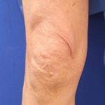 Knee Tightening Before & After Patient #14190