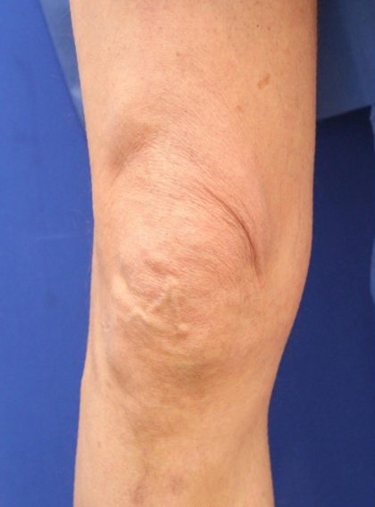 Knee Tightening Before & After Patient #14190