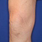 Knee Tightening Before & After Patient #14190