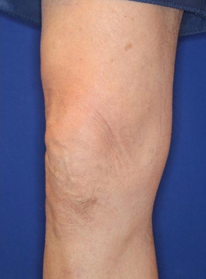 Knee Tightening Before & After Patient #14190