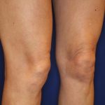 Knee Tightening Before & After Patient #14191