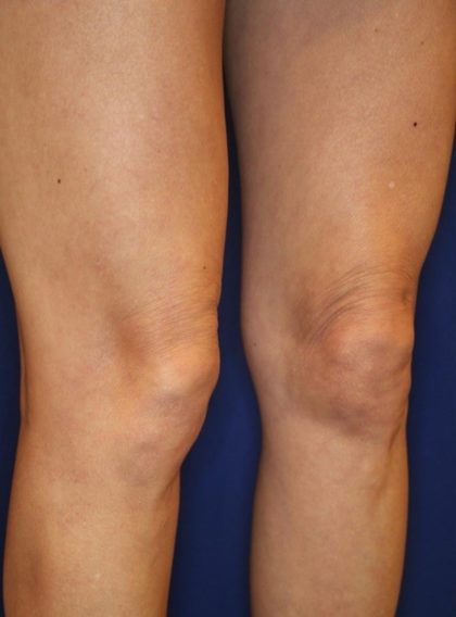 Knee Tightening Before & After Patient #14191