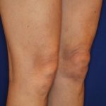 Knee Tightening Before & After Patient #14191