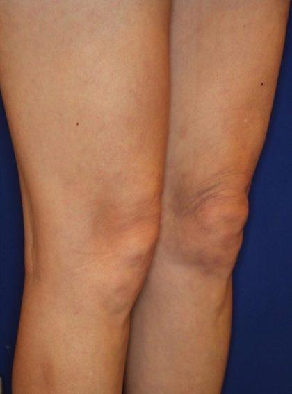 Knee Tightening Before & After Patient #14191