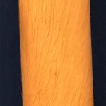 Laser Hair Removal Before & After Patient #14186