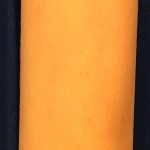 Laser Hair Removal Before & After Patient #14186
