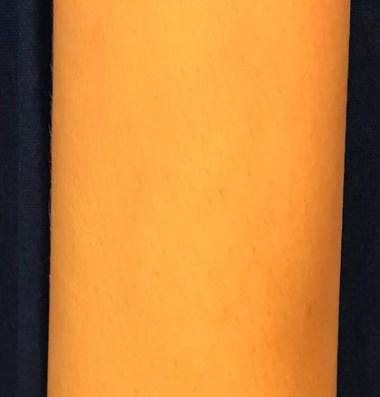 Laser Hair Removal Before & After Patient #14186