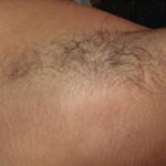 Laser Hair Removal Before & After Patient #14187
