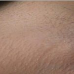 Laser Hair Removal Before & After Patient #14187