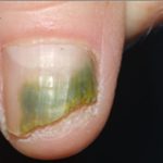 Nail Fungus Removal Before & After Patient #14195