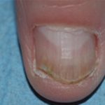 Nail Fungus Removal Before & After Patient #14195