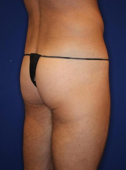 Non-Surgical Butt Lift Before & After Patient #14184