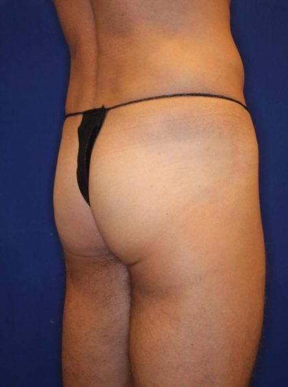Non-Surgical Butt Lift Before & After Patient #14184