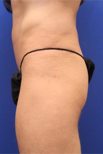 Non-Surgical Butt Lift Before & After Patient #14175