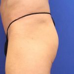 Non-Surgical Butt Lift Before & After Patient #14175