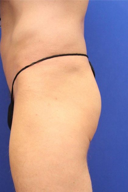 Non-Surgical Butt Lift Before & After Patient #14175