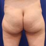 Non-Surgical Butt Lift Before & After Patient #14176