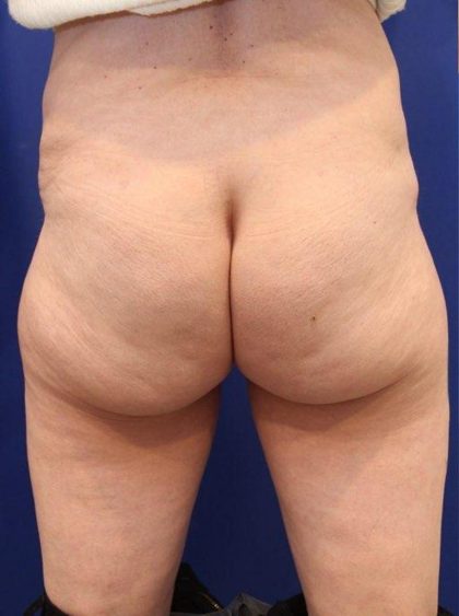 Non-Surgical Butt Lift Before & After Patient #14176