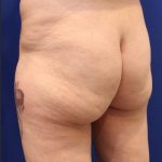 Non-Surgical Butt Lift Before & After Patient #14176