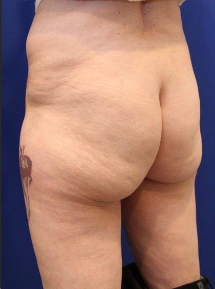 Non-Surgical Butt Lift Before & After Patient #14176