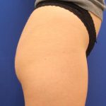 Non-Surgical Butt Lift Before & After Patient #14178