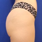 Non-Surgical Butt Lift Before & After Patient #14178