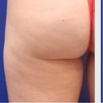 Non-Surgical Butt Lift Before & After Patient #14181