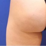 Non-Surgical Butt Lift Before & After Patient #14181