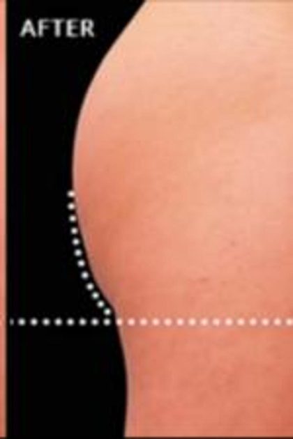 Non-Surgical Butt Lift Before & After Patient #14182