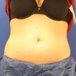CoolSculpting Elite Before & After Patient #14212