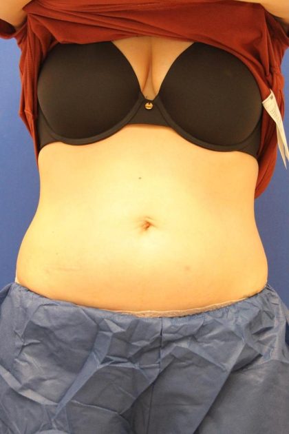 CoolSculpting Elite Before & After Patient #14212