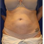 CoolSculpting Elite Before & After Patient #14212