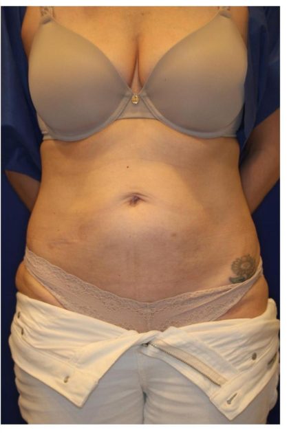 CoolSculpting Elite Before & After Patient #14212
