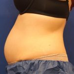 CoolSculpting Elite Before & After Patient #14212