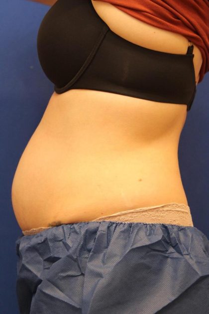 CoolSculpting Elite Before & After Patient #14212