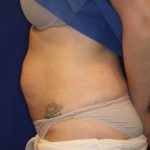 CoolSculpting Elite Before & After Patient #14212