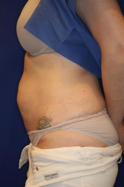 CoolSculpting Elite Before & After Patient #14212