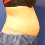 CoolSculpting Elite Before & After Patient #14212