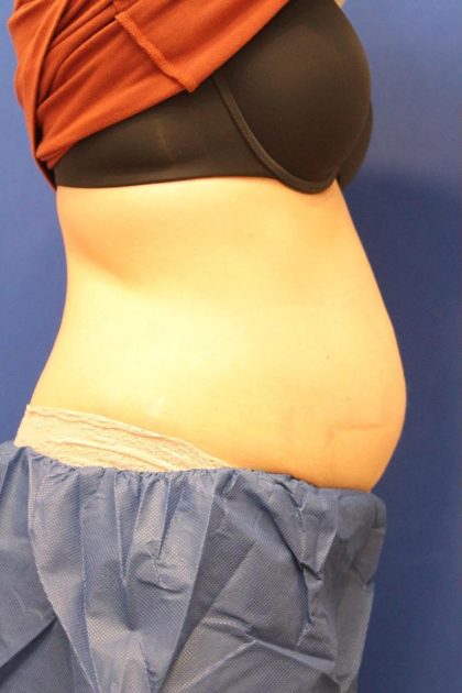 CoolSculpting Elite Before & After Patient #14212
