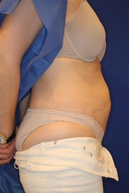 CoolSculpting Elite Before & After Patient #14212