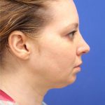CoolSculpting Elite Before & After Patient #14213