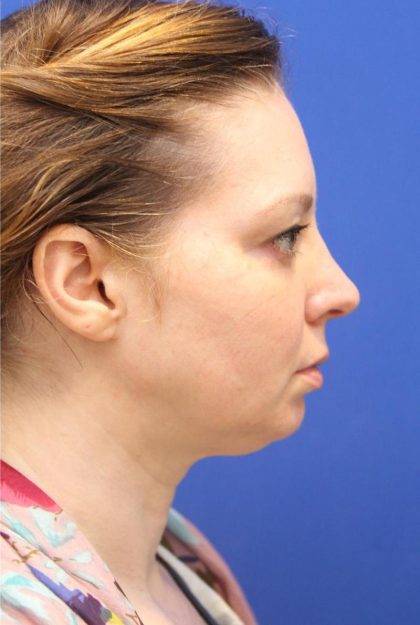 CoolSculpting Elite Before & After Patient #14213